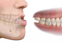 Más allá de la estética: La mala mordida, una amënaza silenciosa para la salud integral