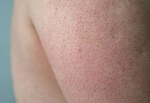 Granitos en los brazos: aunque no representan un problema gräve de salud, resultan poco estéticos (+ Detalles)
