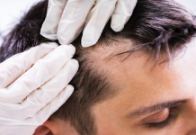 Descubren un novedoso método que podría revertir la alopecia, abriendo una puerta real y efectiva a millones de personas