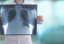 Científicos descubren una nueva técnica que permite llegar a los tümores de pulmón más escondidos (+ Detalles)