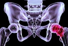 Descubren posible fin de la artrosis: hallan por qué se destrüye el cartílago y cómo regenerarlo