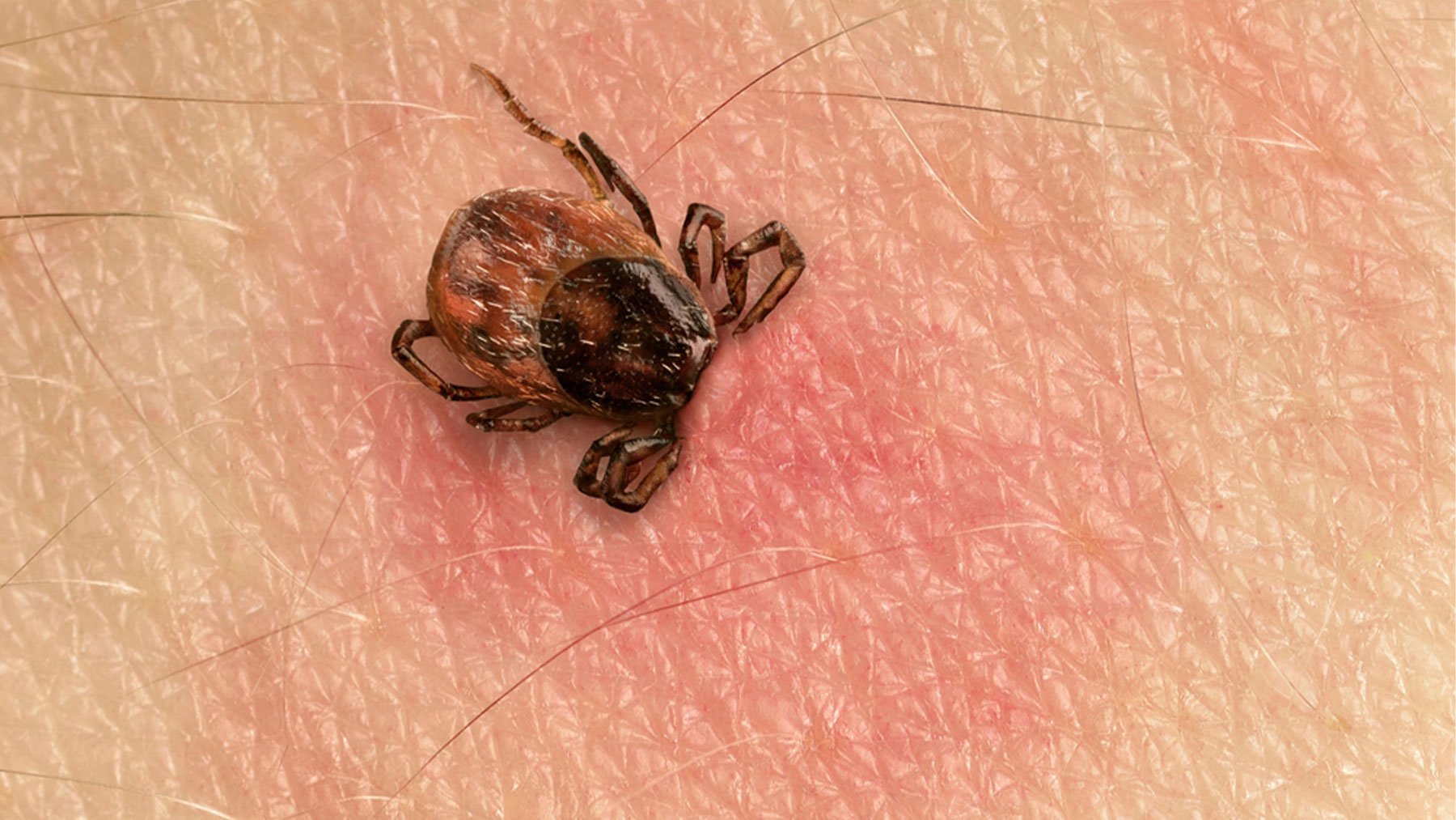 Expertos han descubierto cómo detectar la enfêrmëdad de Lyme antes de que los síntomas aparezcan (+ Detalles)