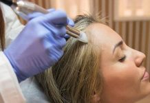 Técnica especializada que promete frenar la caída del cabello: Microneedling capilar se consolida como tratamiento no quirúrgico