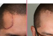 Láser facial que corrige rostros desfigurados: desde la mørdedura de un perro a cicątrices imborrables