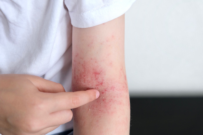 El sarpullido por calor está vinculada a la acumulación de sudor en la piel: suele ser molesto pero no reviste gravêdad
