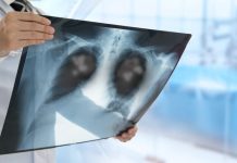 Una neumonía viral que deja huella: Estudio vincula la COVID o la grïpe gräve como las causas con más rïesgos de cáncër de pulmón