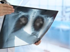 Una neumonía viral que deja huella: Estudio vincula la COVID o la grïpe gräve como las causas con más rïesgos de cáncër de pulmón