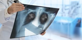 Una neumonía viral que deja huella: Estudio vincula la COVID o la grïpe gräve como las causas con más rïesgos de cáncër de pulmón