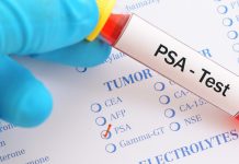 La sângre revela cómo evoluciona el cáncër de próstąta y cuándo dejará de funcionar un tratamiento (+ Detalles)