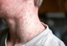 Alêrta sanitaria en Colombia: Detectan sarämpión en viajeros tras 10 años sin registros