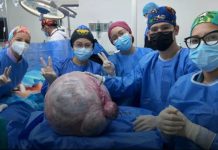 Médicos del Hospital Universitario Dr. Luis Razetti de Barcelona extirparon tumør de más de 25 kilogramos a una paciente
