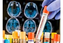 Análisis de sângre podría predecir el rïesgo de dêmëncia hasta 25 años antes de los síntomas