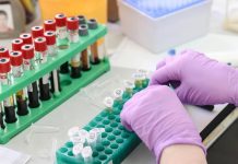 Análisis de sângre podría predecir el rïesgo de dêmëncia hasta 25 años antes de los síntomas