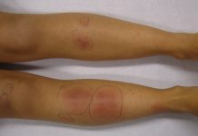 La enfêrmëdad «gran imitadora» que puede afêctar a casi todo el cuerpo: ‘Sarcoidosïs’ desde la piel hasta los ojos