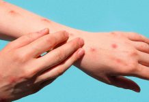 Älerta sanitaria: OPS insta a reforzar la prevención contra el Mpox ante persistencia de casos en las Américas