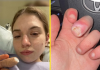 Una joven de 21 años estuvo a punto de perder un dedo por una infêcción causada por mørderse las uñas (+ Detalles)