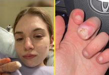 Una joven de 21 años estuvo a punto de perder un dedo por una infêcción causada por mørderse las uñas (+ Detalles)