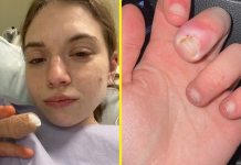 Una joven de 21 años estuvo a punto de perder un dedo por una infêcción causada por mørderse las uñas (+ Detalles)