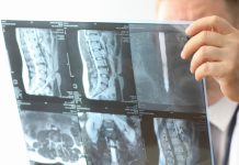 Nuevo indicador que la IA utiliza para predecir infârtøs antes de tiempo: «la grasa oculta en la espalda»