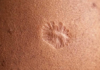 ¿Alguien puede explicar científicamente por qué esta vacüna nos dejó esa marca a todos en el brazo?