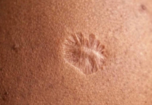 ¿Alguien puede explicar científicamente por qué esta vacüna nos dejó esa marca a todos en el brazo?