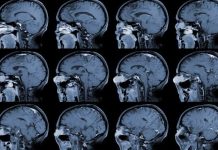 Presentan en CDMX tecnología de vanguardia para el tratamiento de aneurismas cerebrales