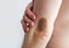 La exposición solar y la piel clara figuran entre los principales factores de riesgö del melanoma