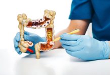Aumentan los casos de cáncër colorrectal en menores de 45 años: la importancia de la detección temprana
