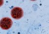 Científicos rusos desarrollan micropartículas de oro y hierro que eliminan cerca del 50 % de células cancerosäs